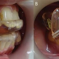 Effects of Wearing a Custom Made Mouth Guard during Static Exercise on Masticatory Muscle Activity in Athletes with Cerebral Palsy