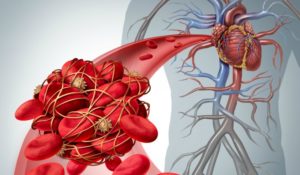 Prologue to a Survey Arrangement 
on Treatment of Venous 
Thrombotic Messes