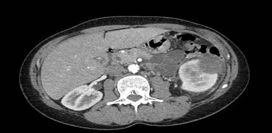 Everolimus and Lenvatinib in a Kidney Metastatic Epithelioid Angiomyolipoma